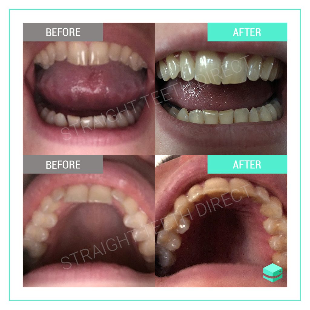 Straight Teeth Direct Review by Leah