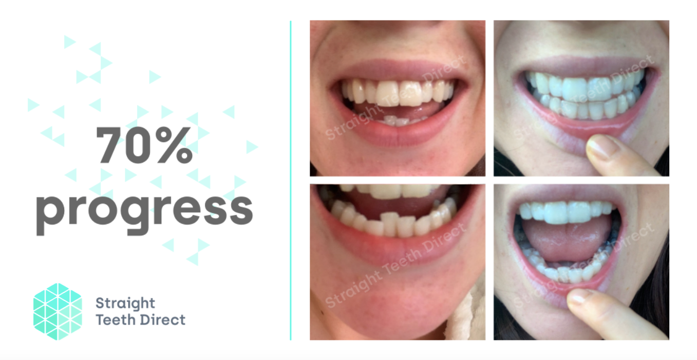 maisie 70% progress with convenient invisible aligners