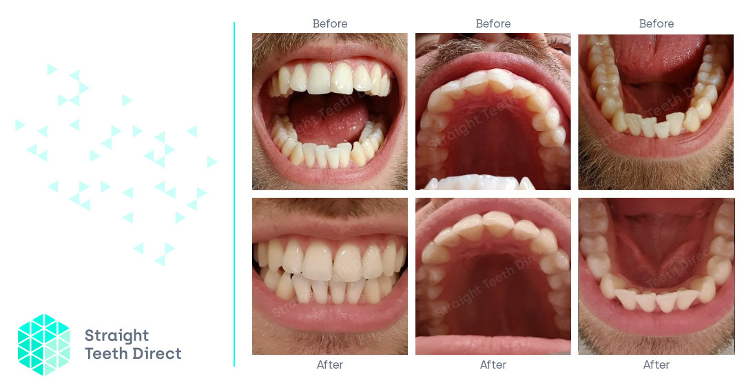 Joe before after 100% - aligners work