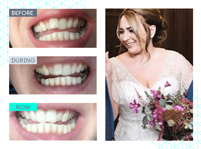 wedding smile makeover