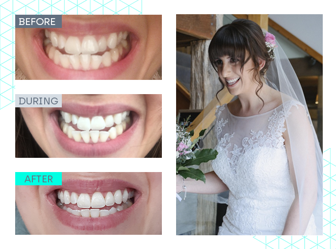 wedding smile makeover