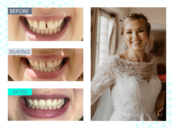 wedding smile makeover