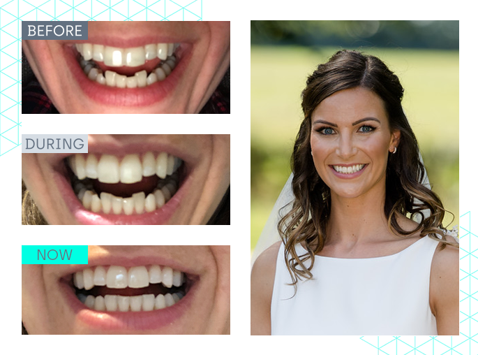 wedding smile makeover