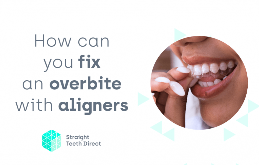 Overbite wondering if clear aligners could fix yours?