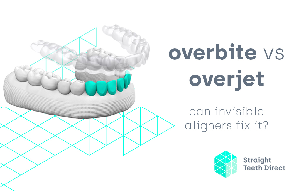 Aligners and overbite vs overjet