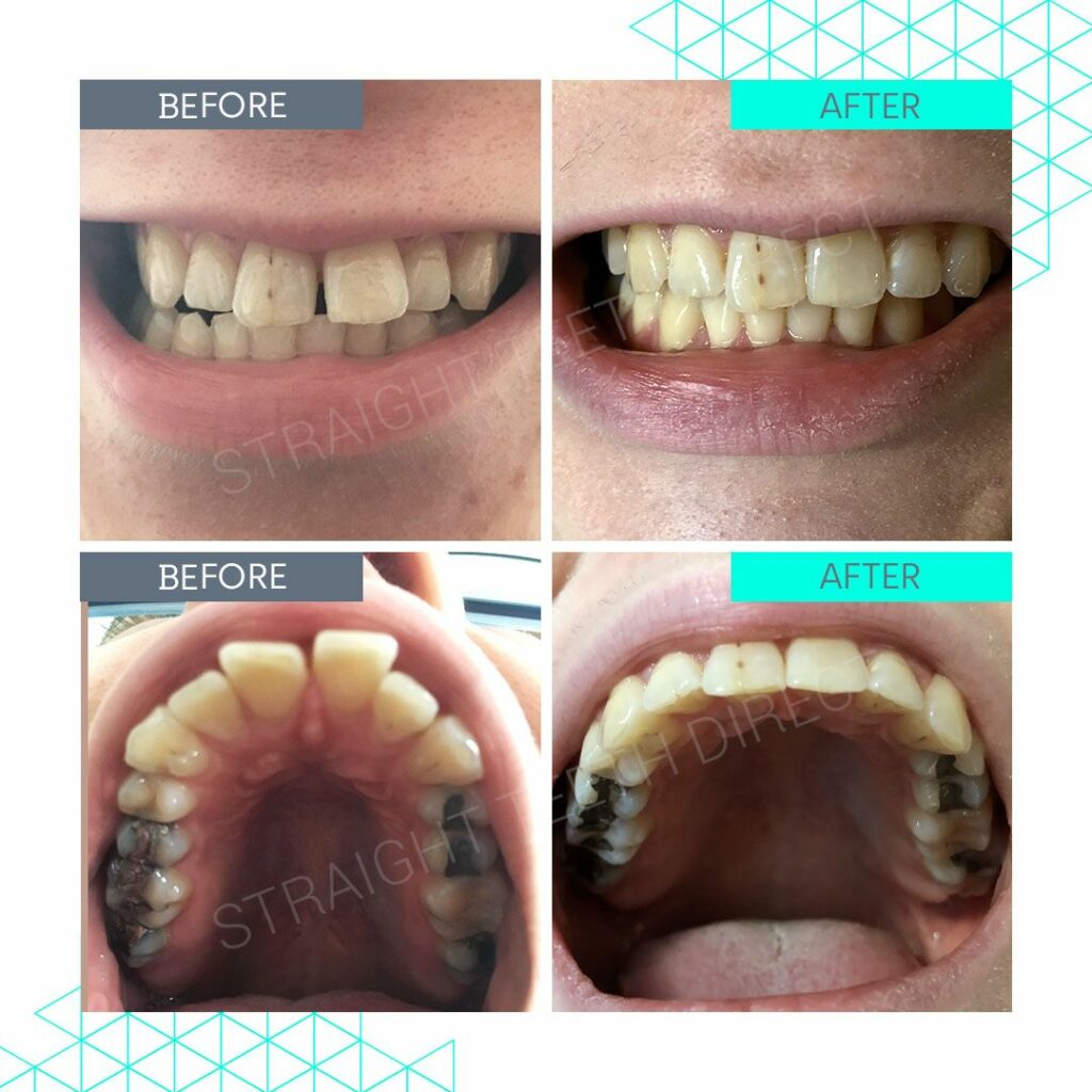 Invisible Teeth Braces At home teeth straightening made simple