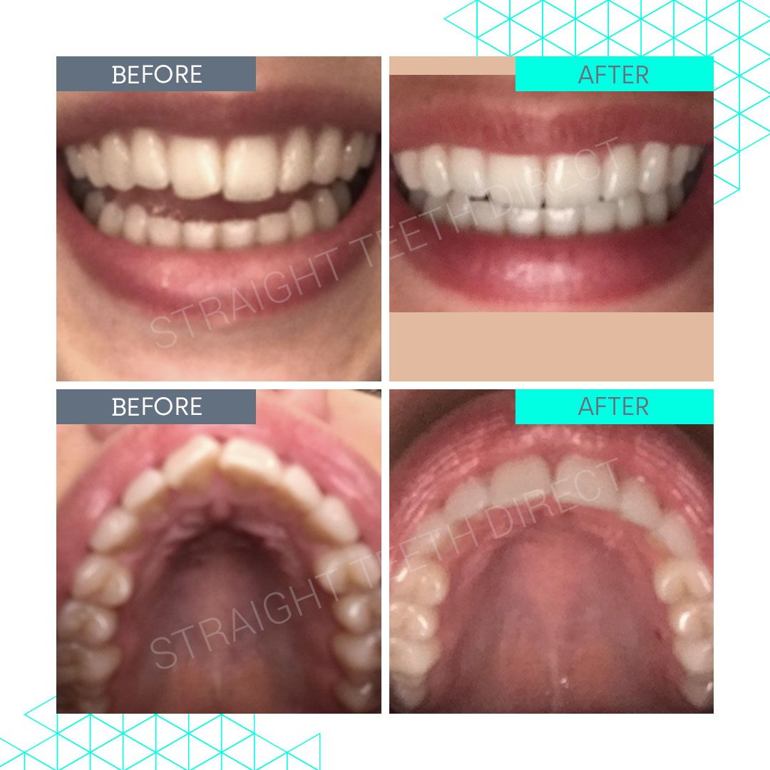 Straight Teeth Direct Review by Beth