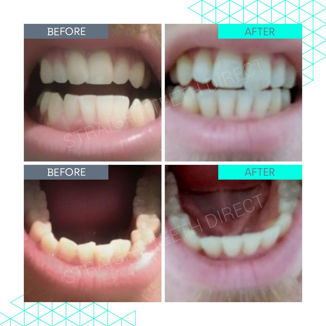 Straight Teeth Direct Review by Rory