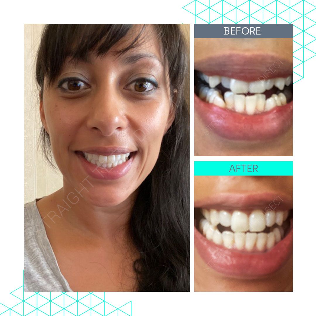 Straight Teeth Direct Review by Estelle