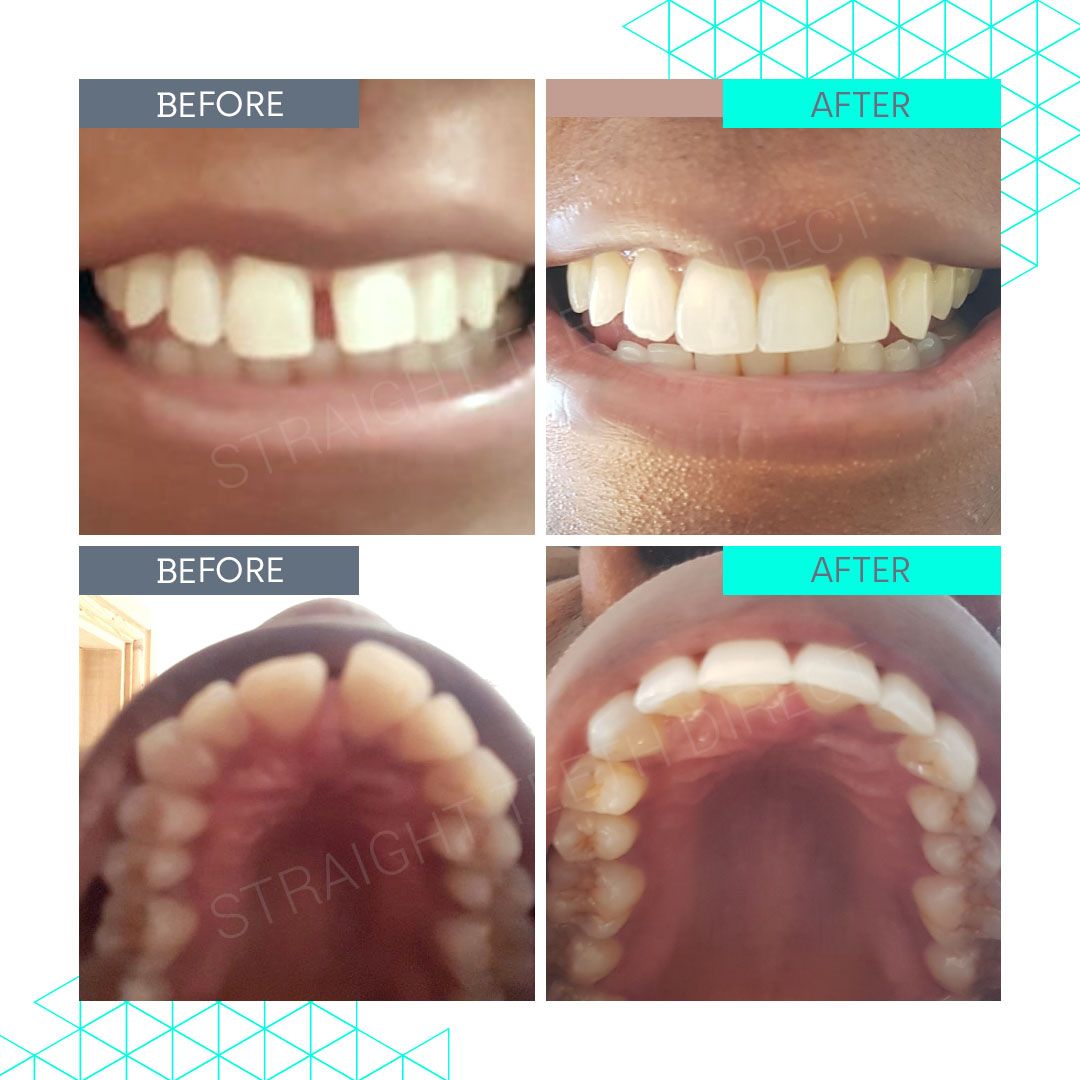 Straight Teeth Direct Review by Marcia