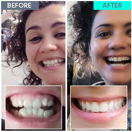 Straight Teeth Direct Review by Noelia Carracedo