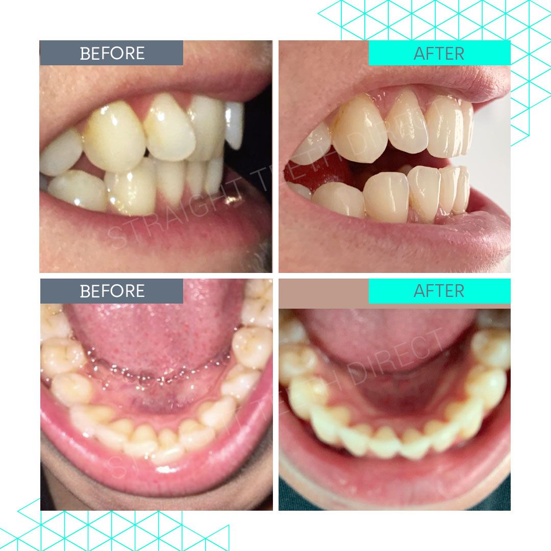 Straight Teeth Direct Review by Nancy