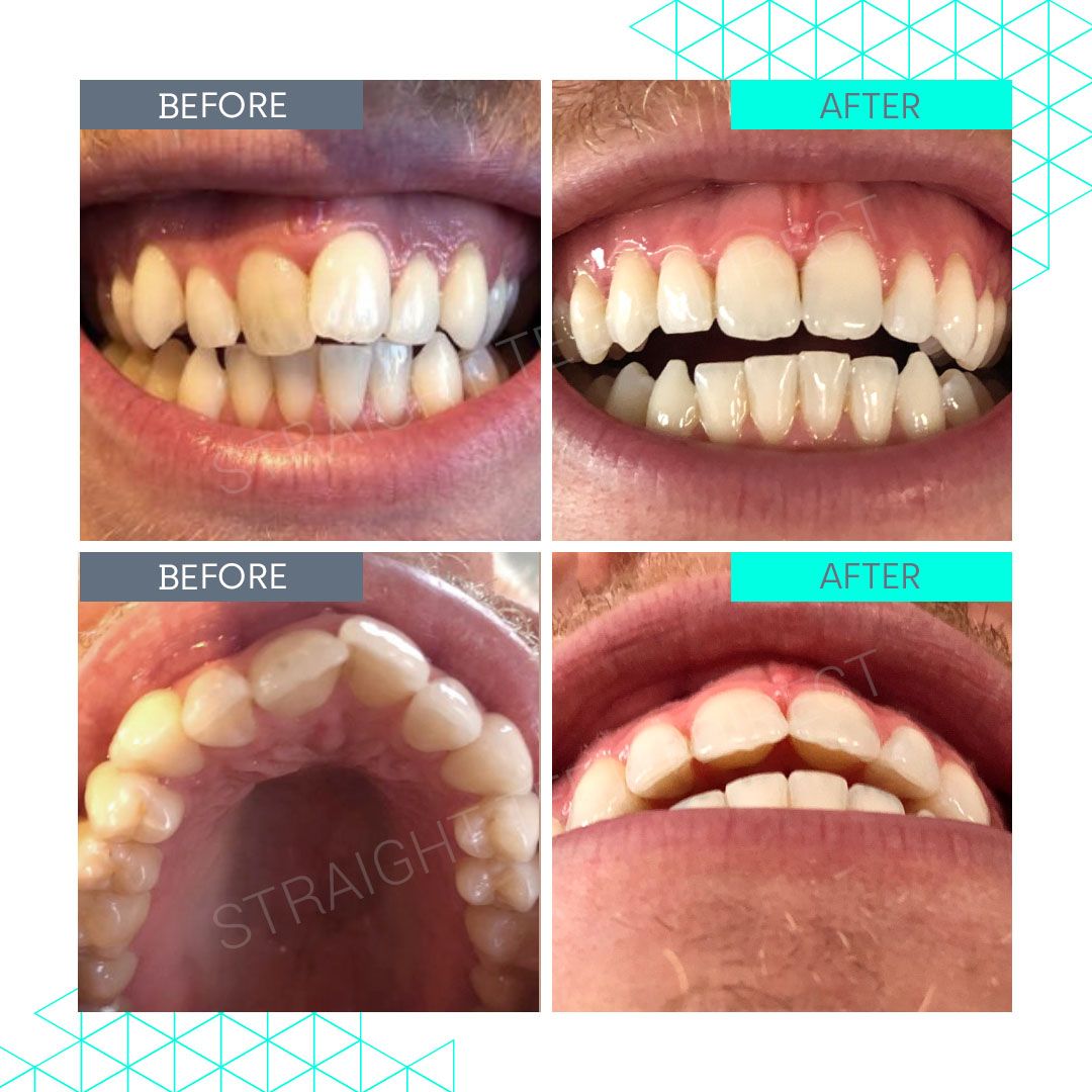 Straight Teeth Direct Review by Edd M.