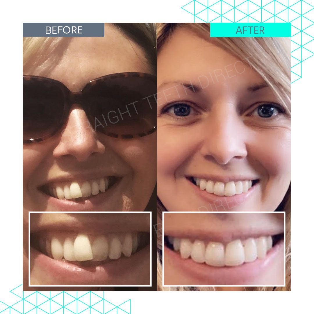 Straight Teeth Direct Review by Sarah