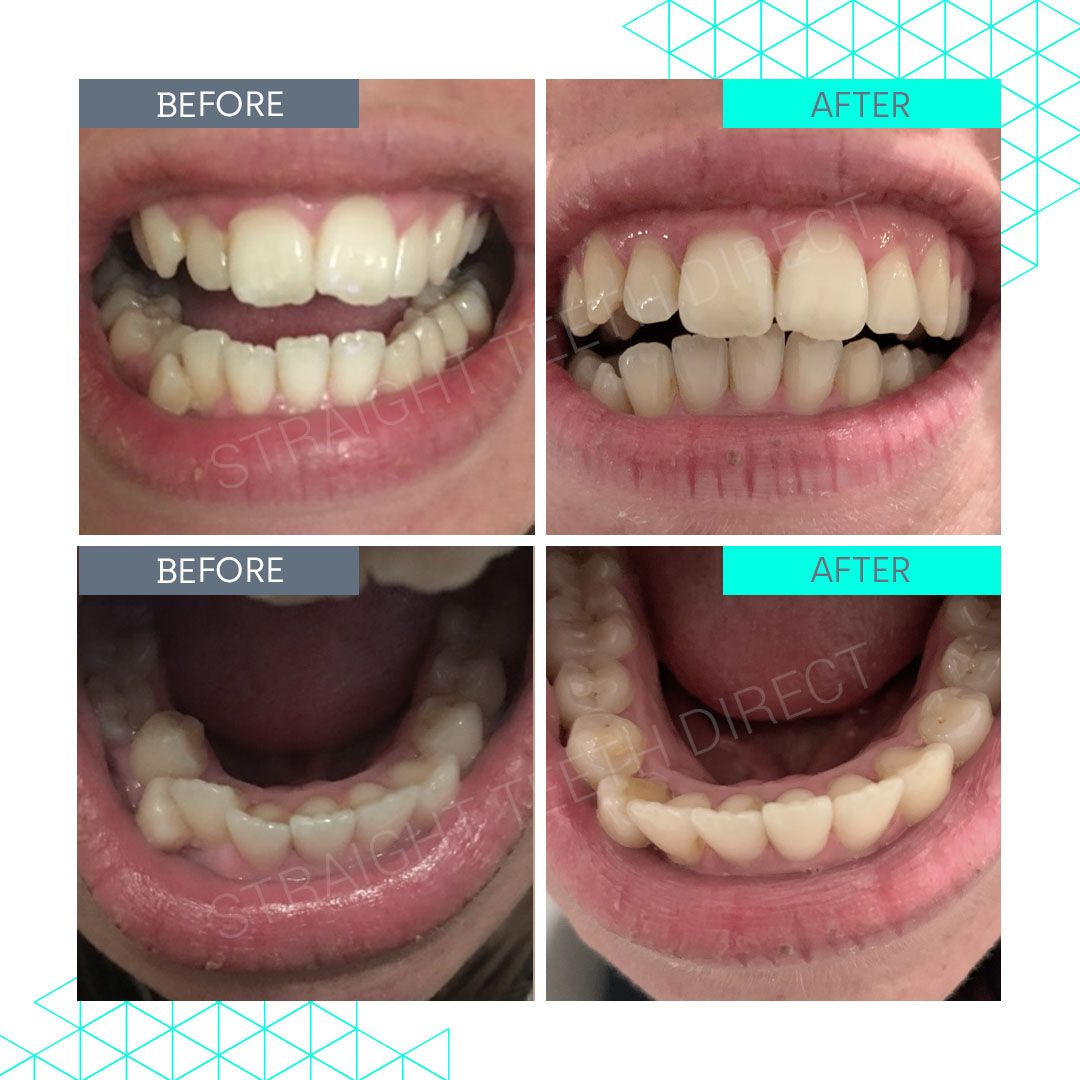 Straight Teeth Direct Review by Becky