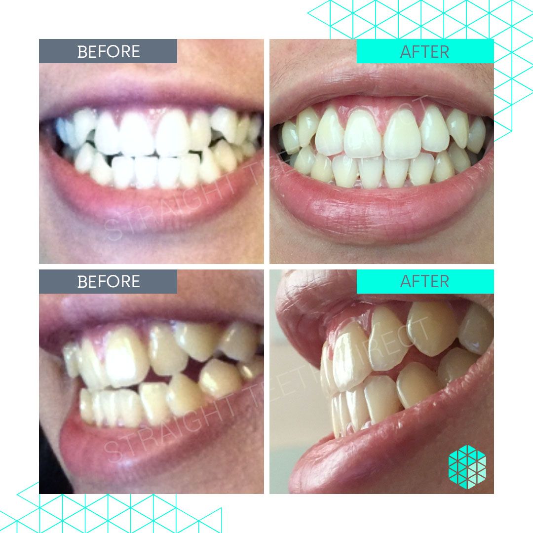 Straight Teeth Direct Review by