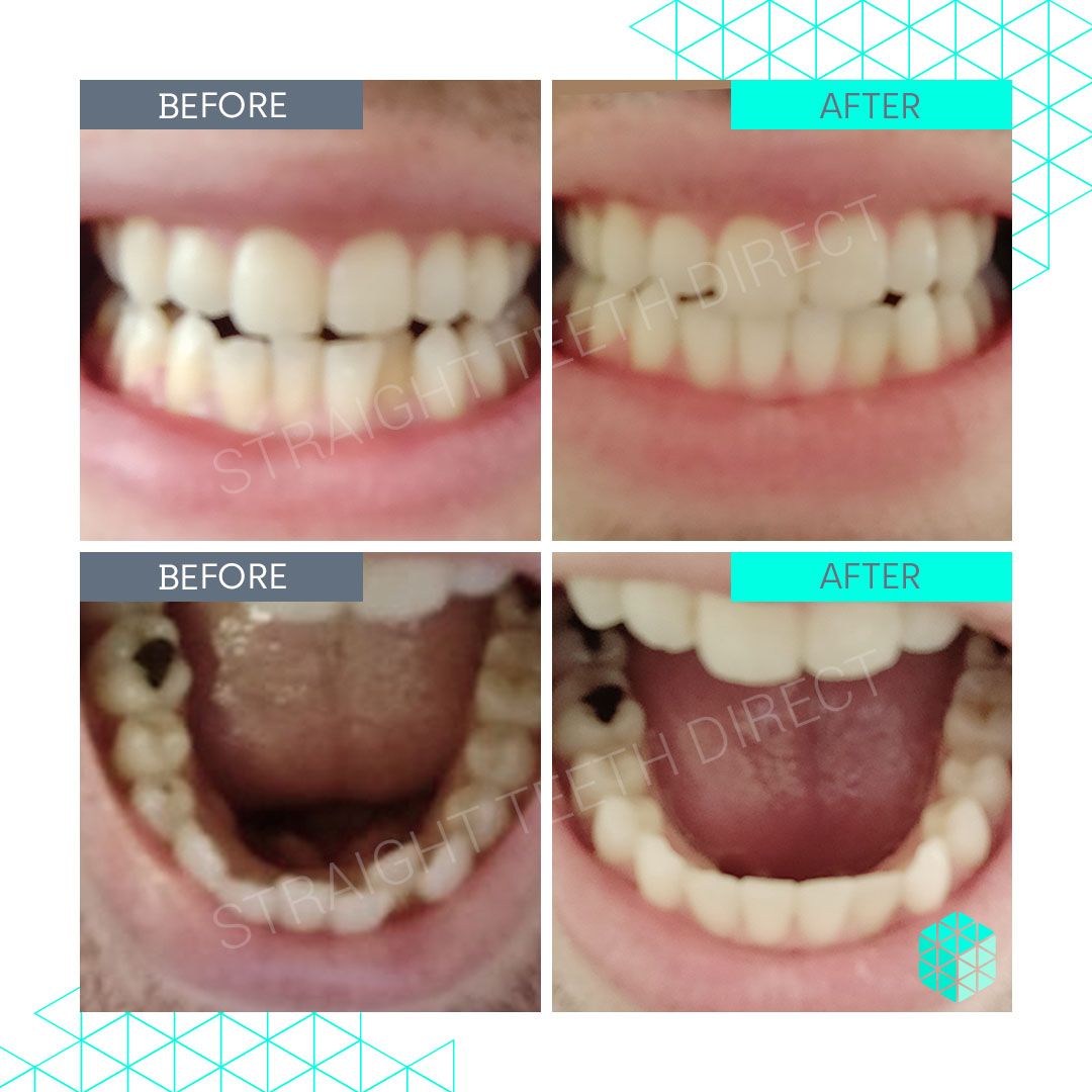 Straight Teeth Direct Review by Andy