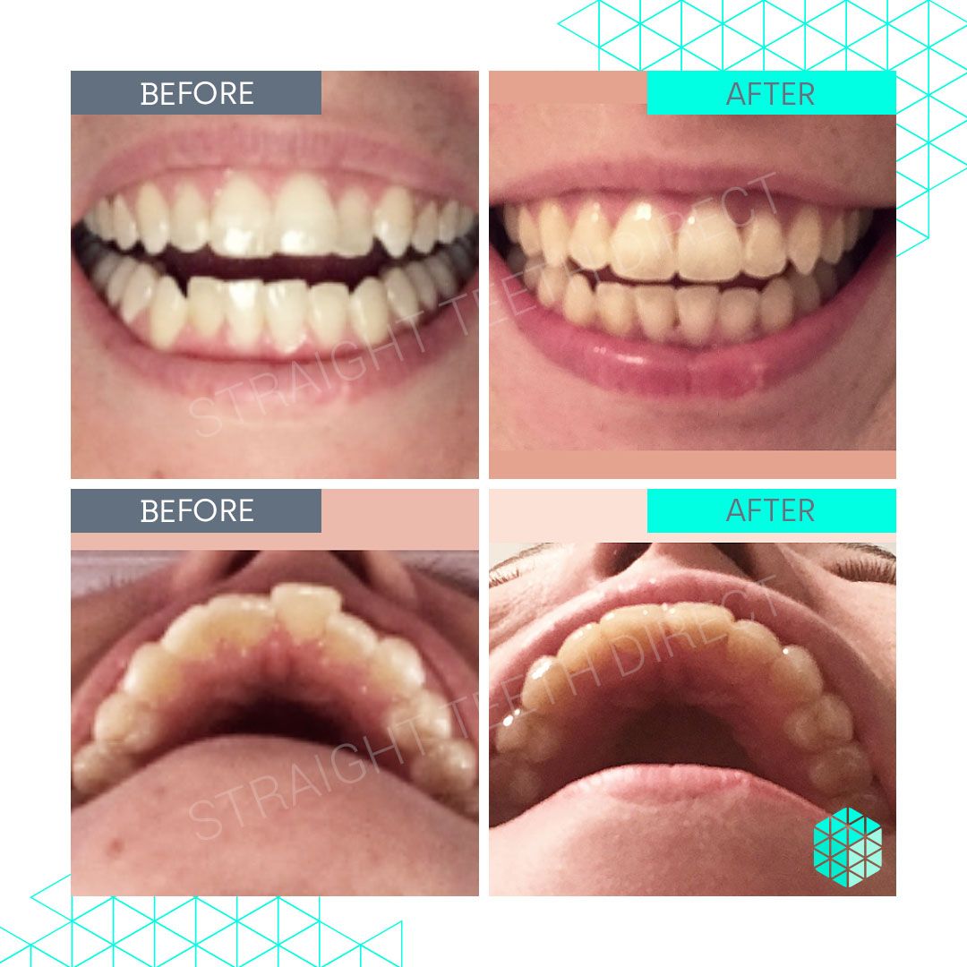 Straight Teeth Direct Review by