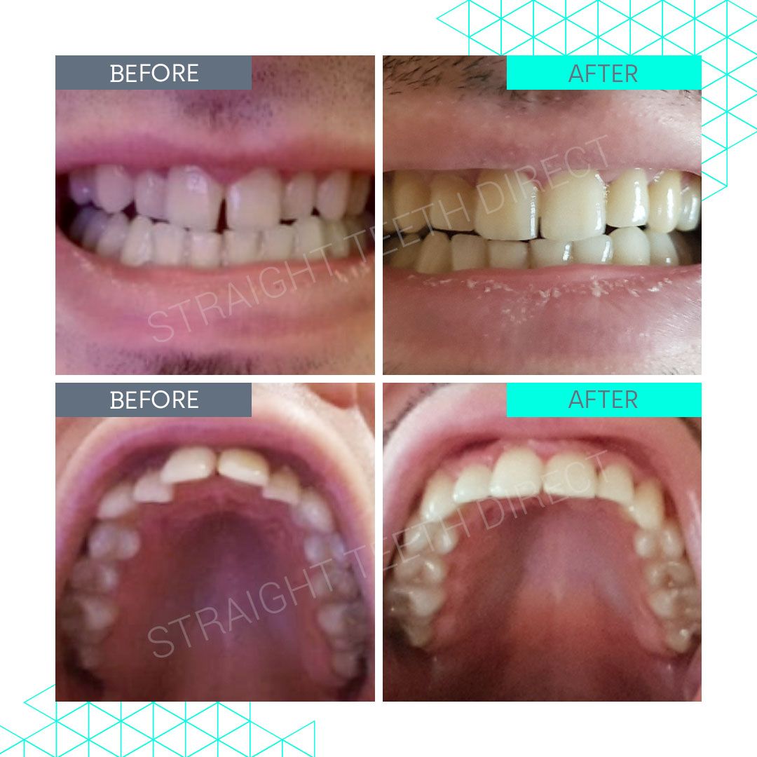 Straight Teeth Direct Review by