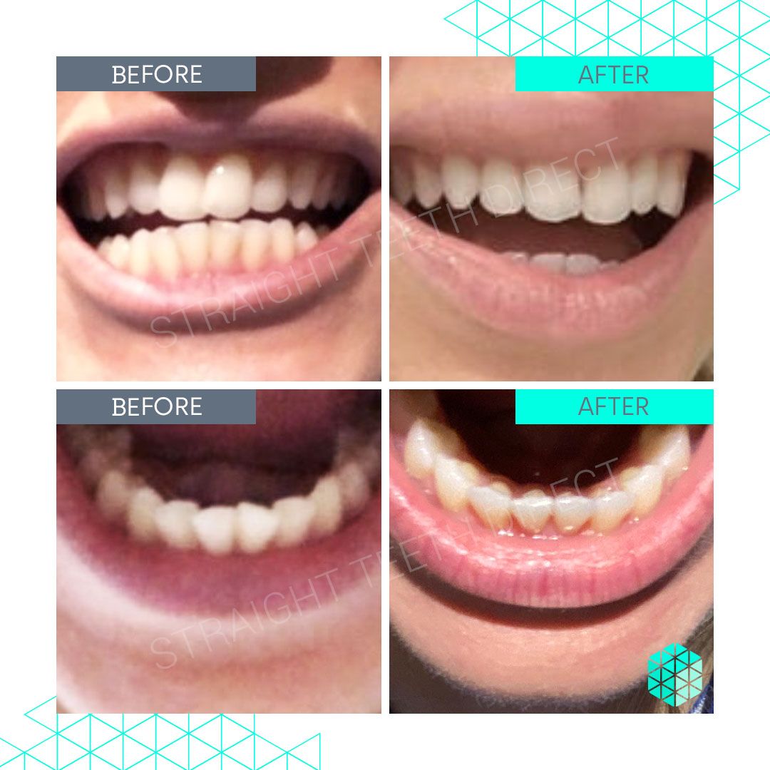 Straight Teeth Direct Review by Barbs