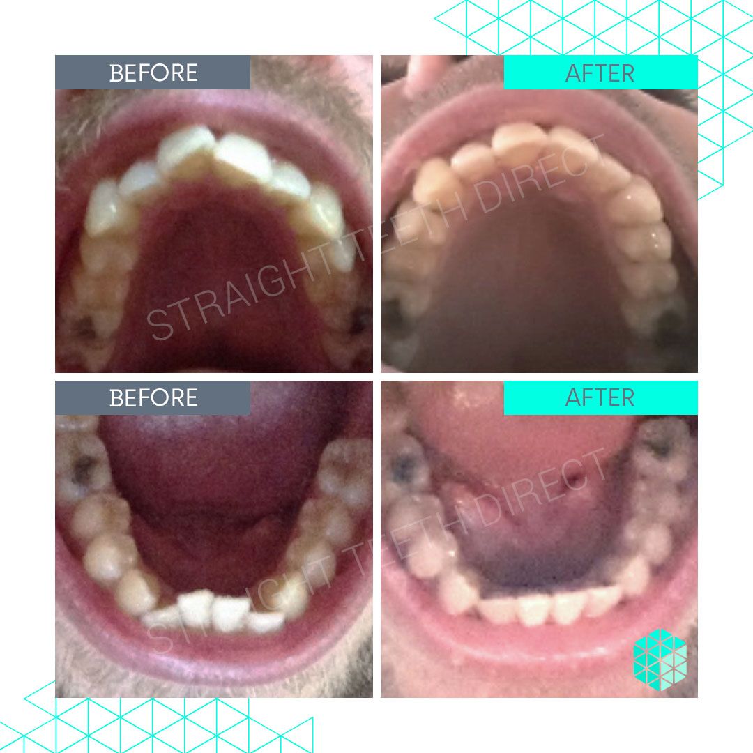 Straight Teeth Direct Review by Chris