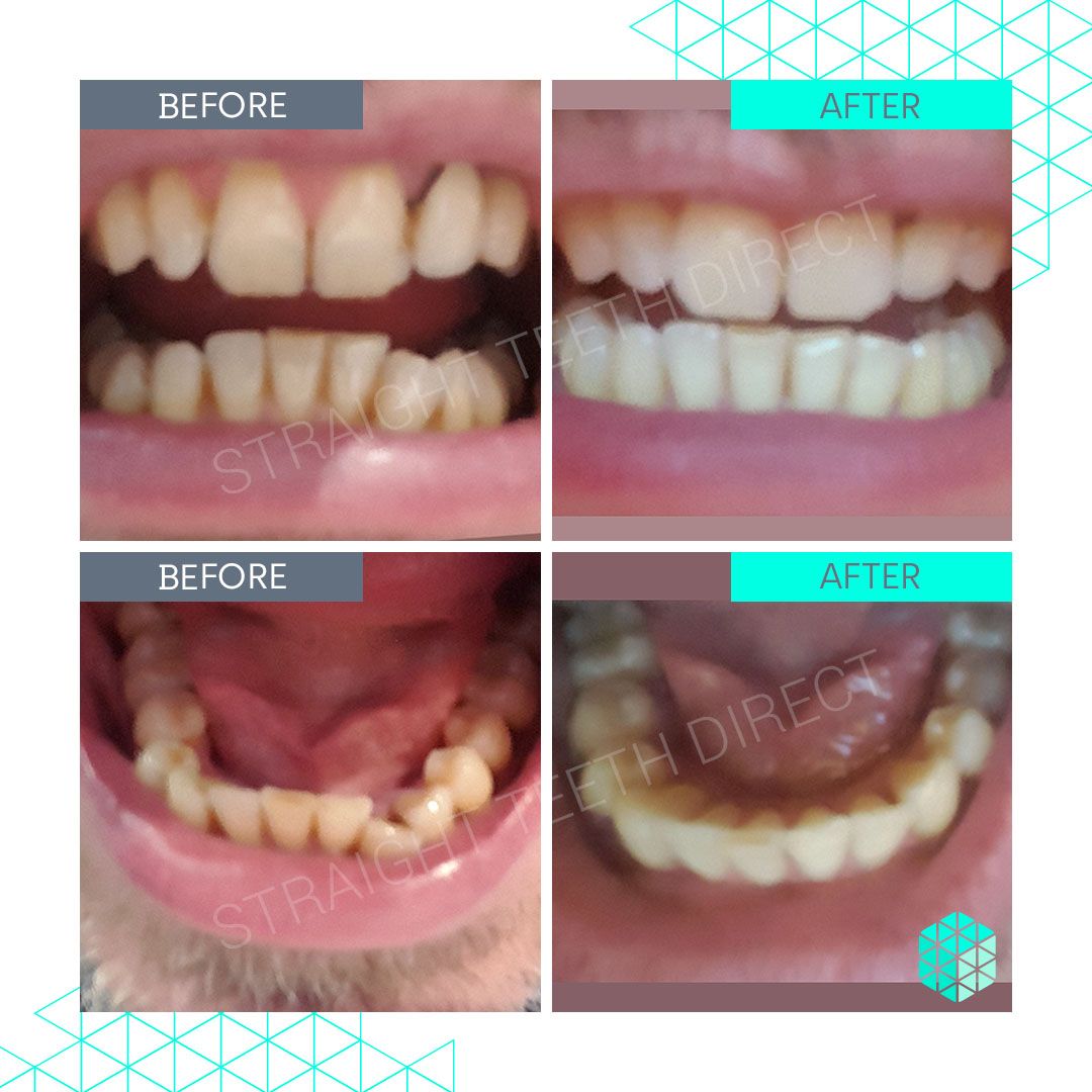 Straight Teeth Direct Review by
