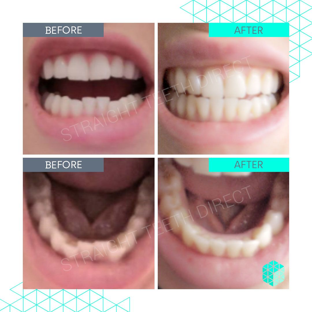 Straight Teeth Direct Review by