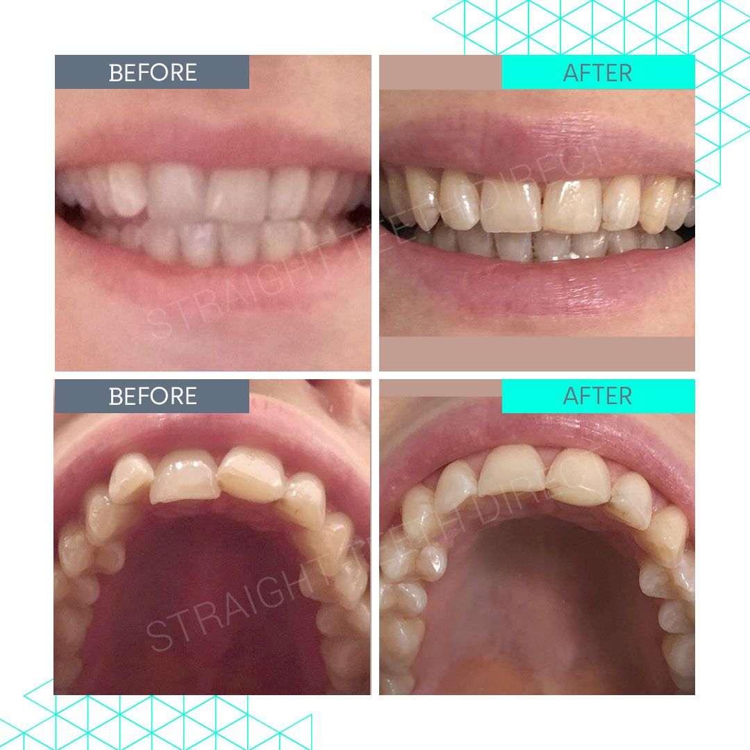 Straight Teeth Direct Review by Emma