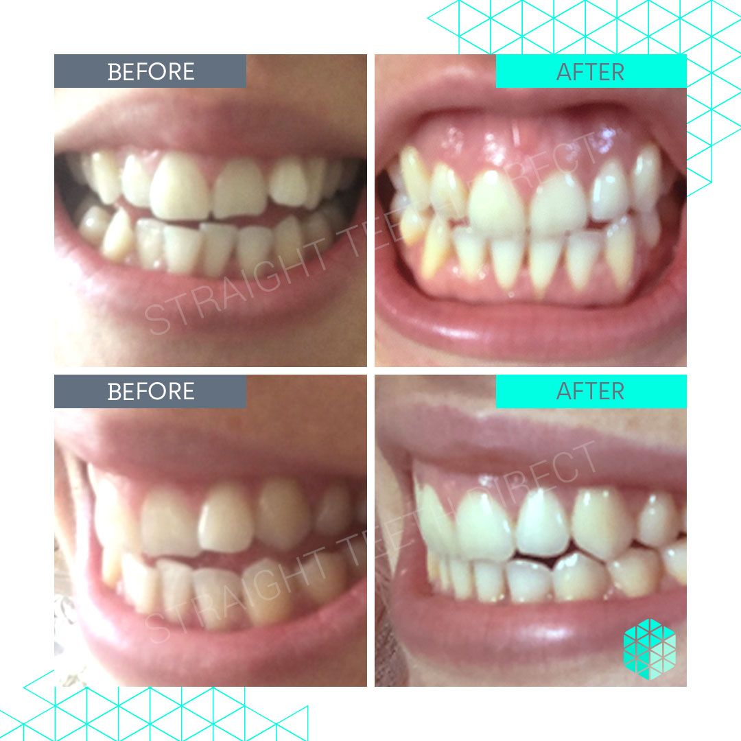 Straight Teeth Direct Review by Gabriella