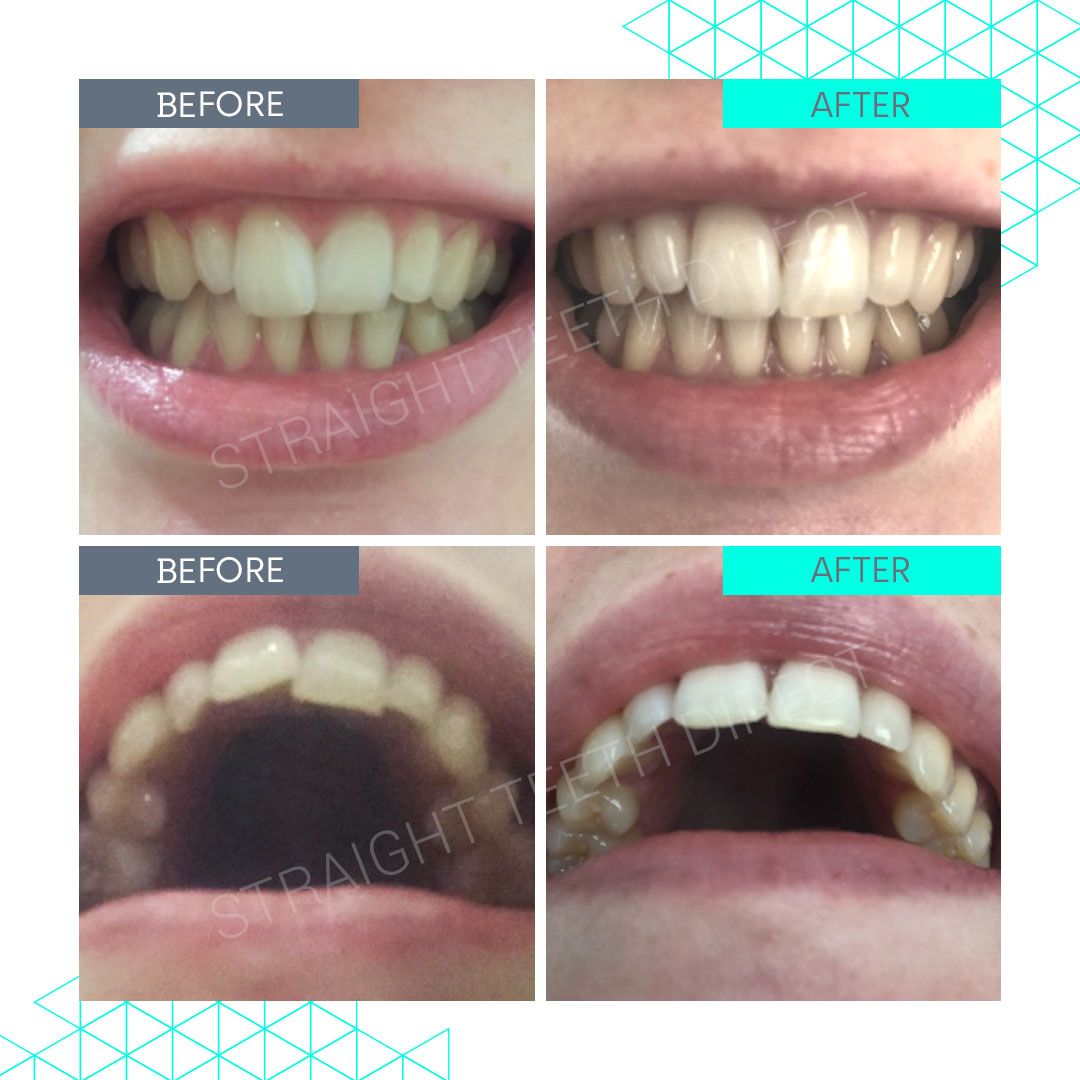 Straight Teeth Direct Review by