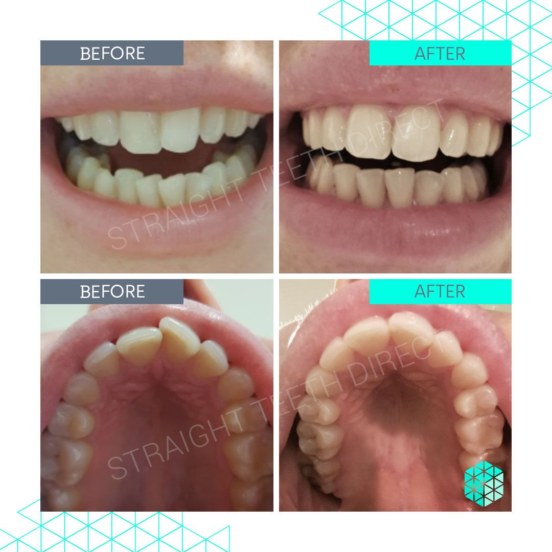 Straight Teeth Direct Review by