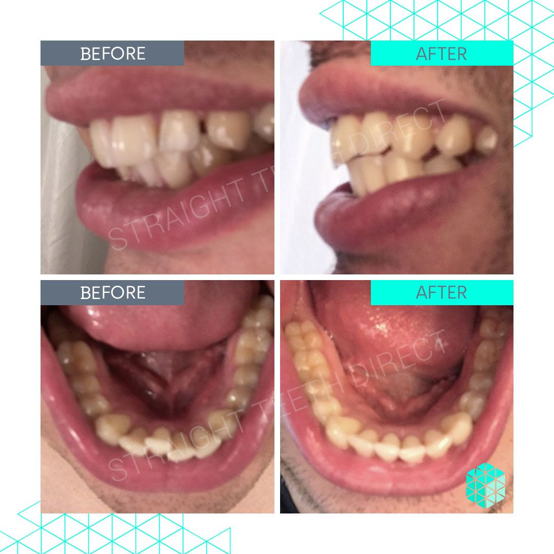 Straight Teeth Direct Review by Jonathan