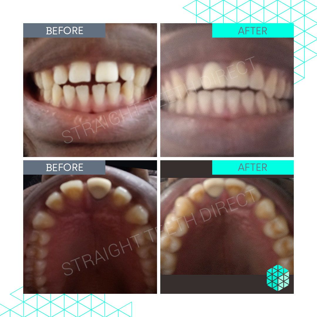 Straight Teeth Direct Review by Joseph