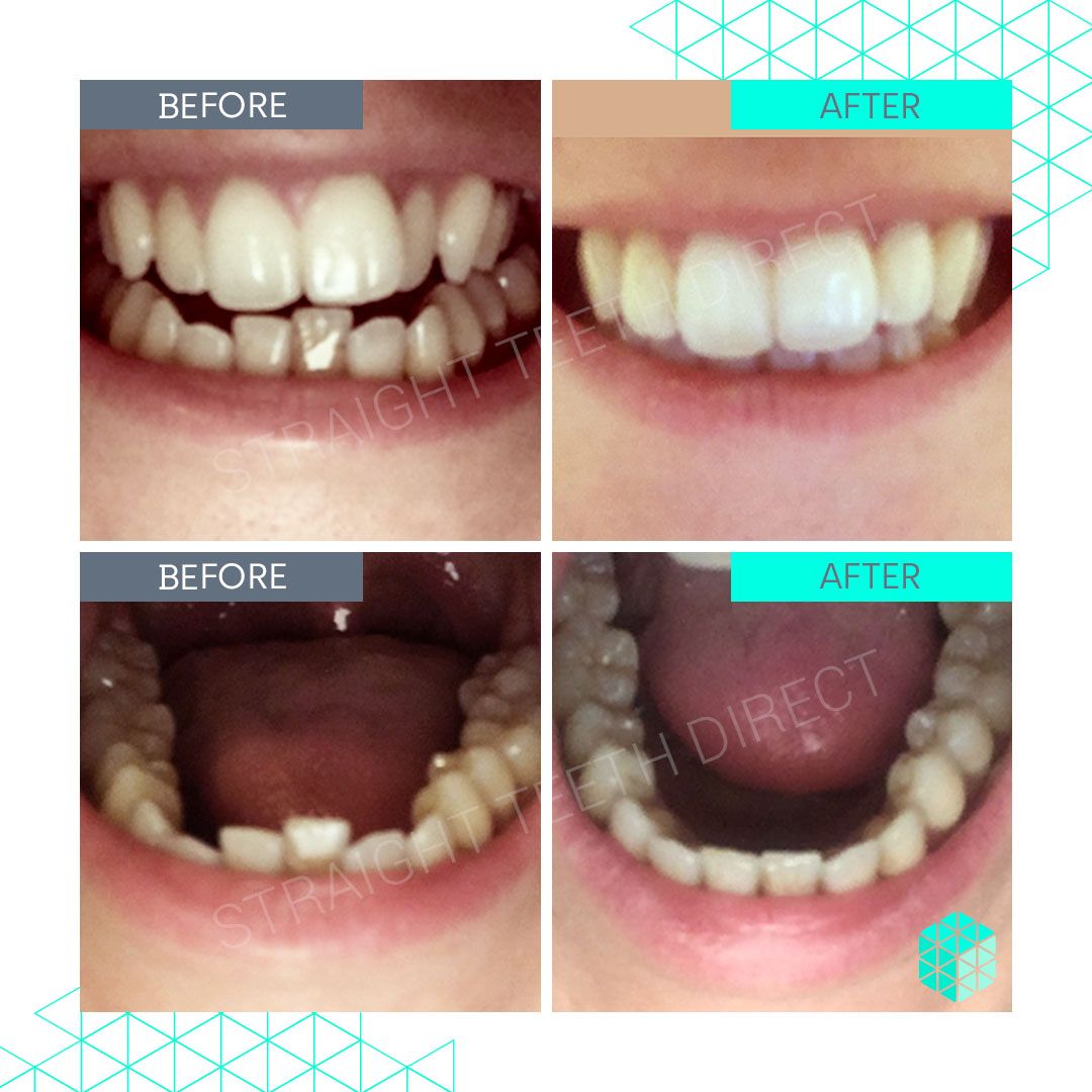 Straight Teeth Direct Review by Karla