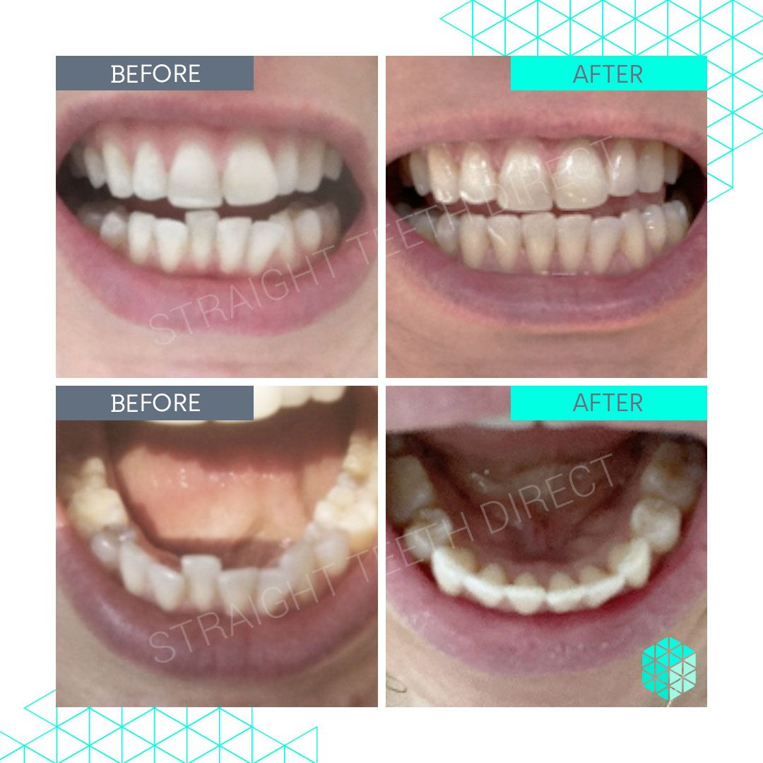 Straight Teeth Direct Review by