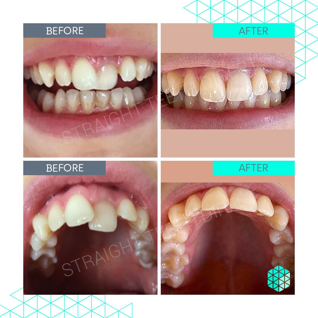 Straight Teeth Direct Review by Kathrin