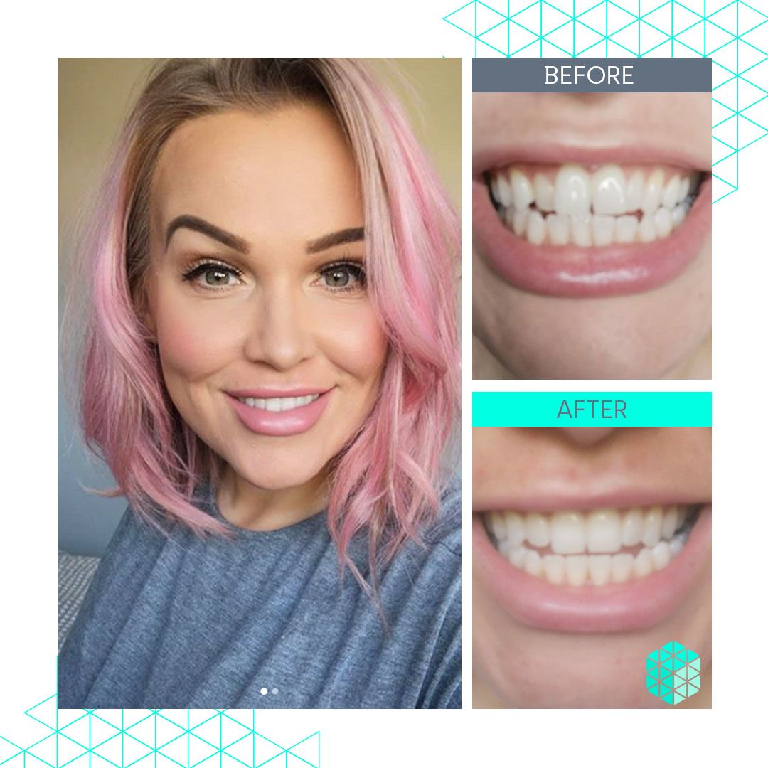 Straight Teeth Direct Review by Laura