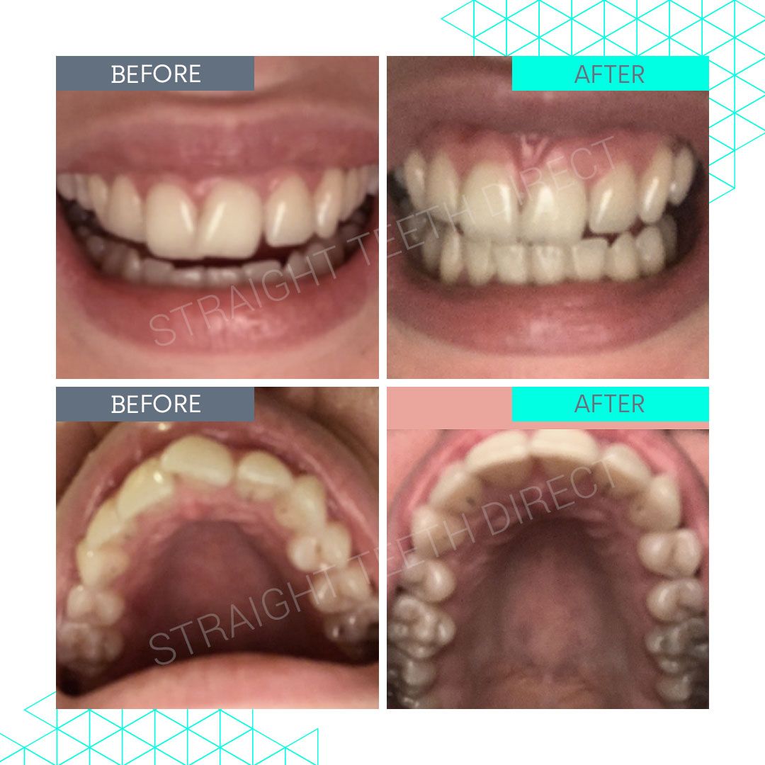 Straight Teeth Direct Review by