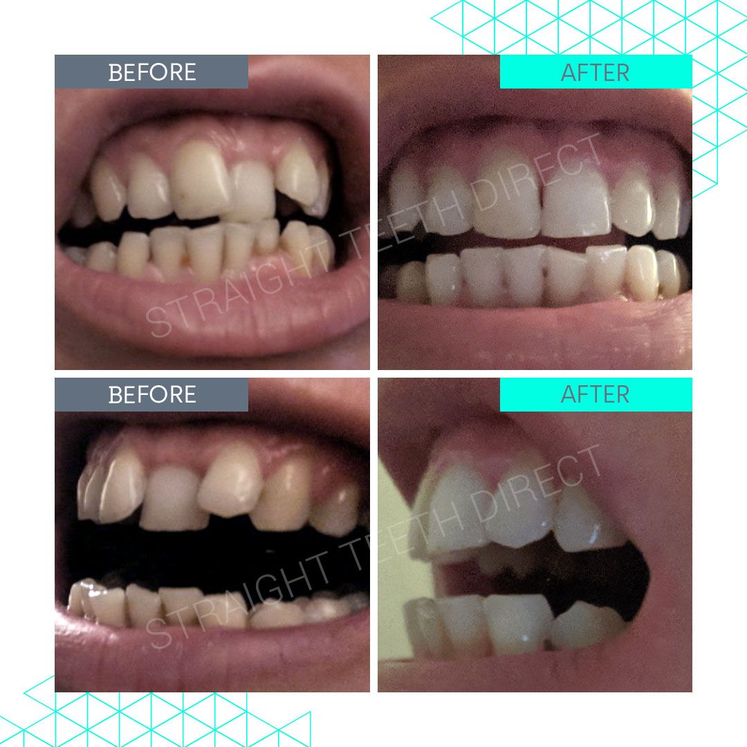 Straight Teeth Direct Review by