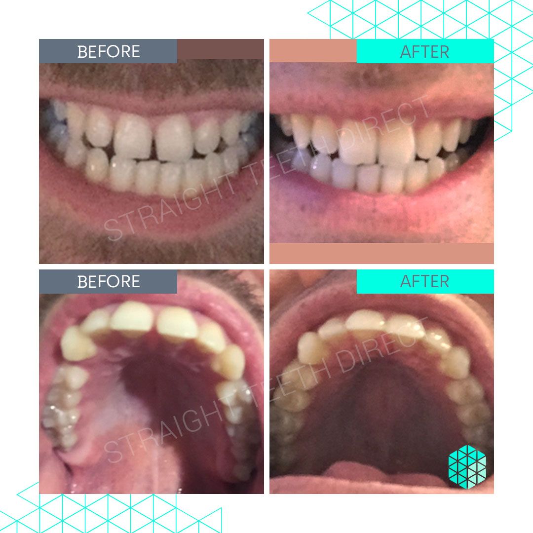 Straight Teeth Direct Review by Luke P