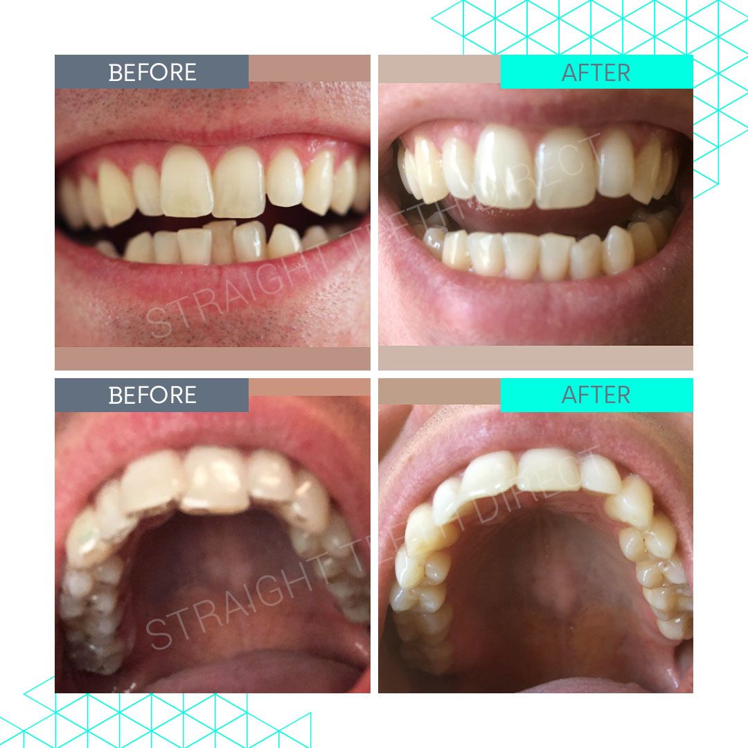 Straight Teeth Direct Review by