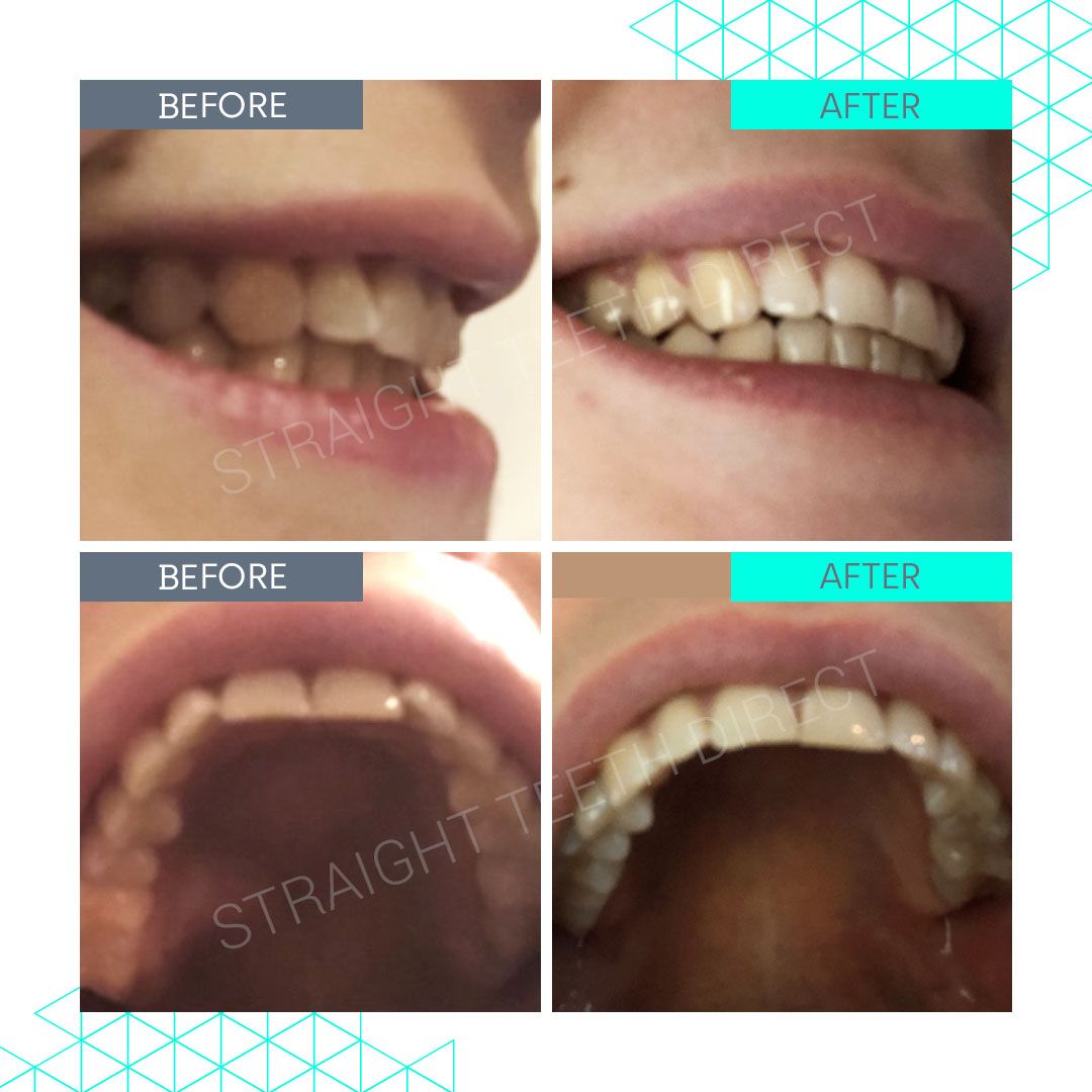 Straight Teeth Direct Review by