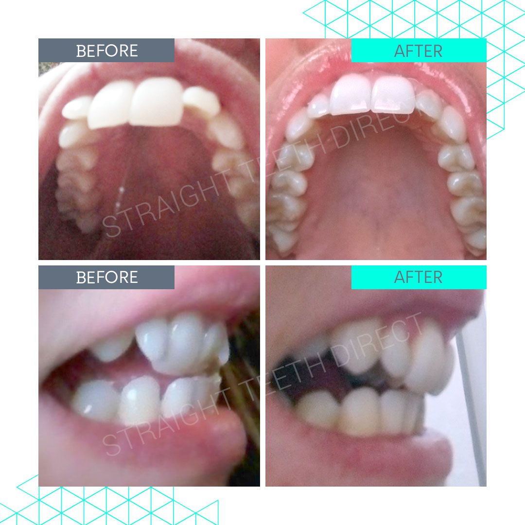 Straight Teeth Direct Review by