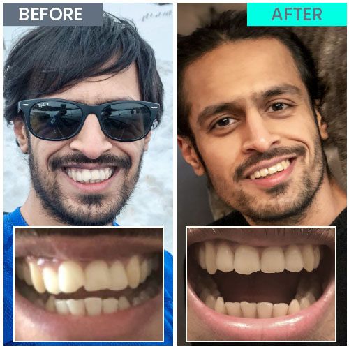 Straight Teeth Direct Review by Prash