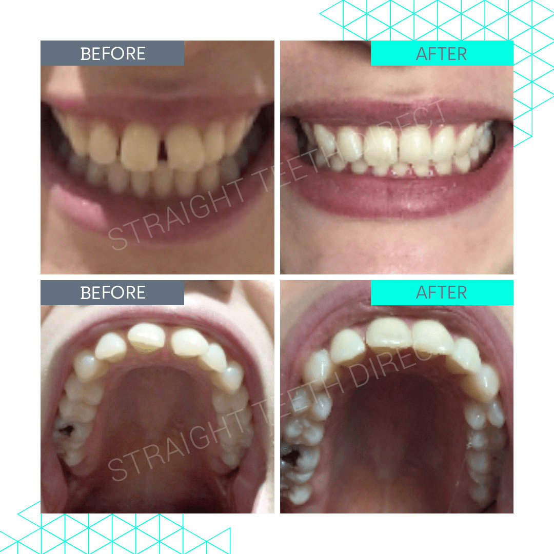 Straight Teeth Direct Review by Rhian