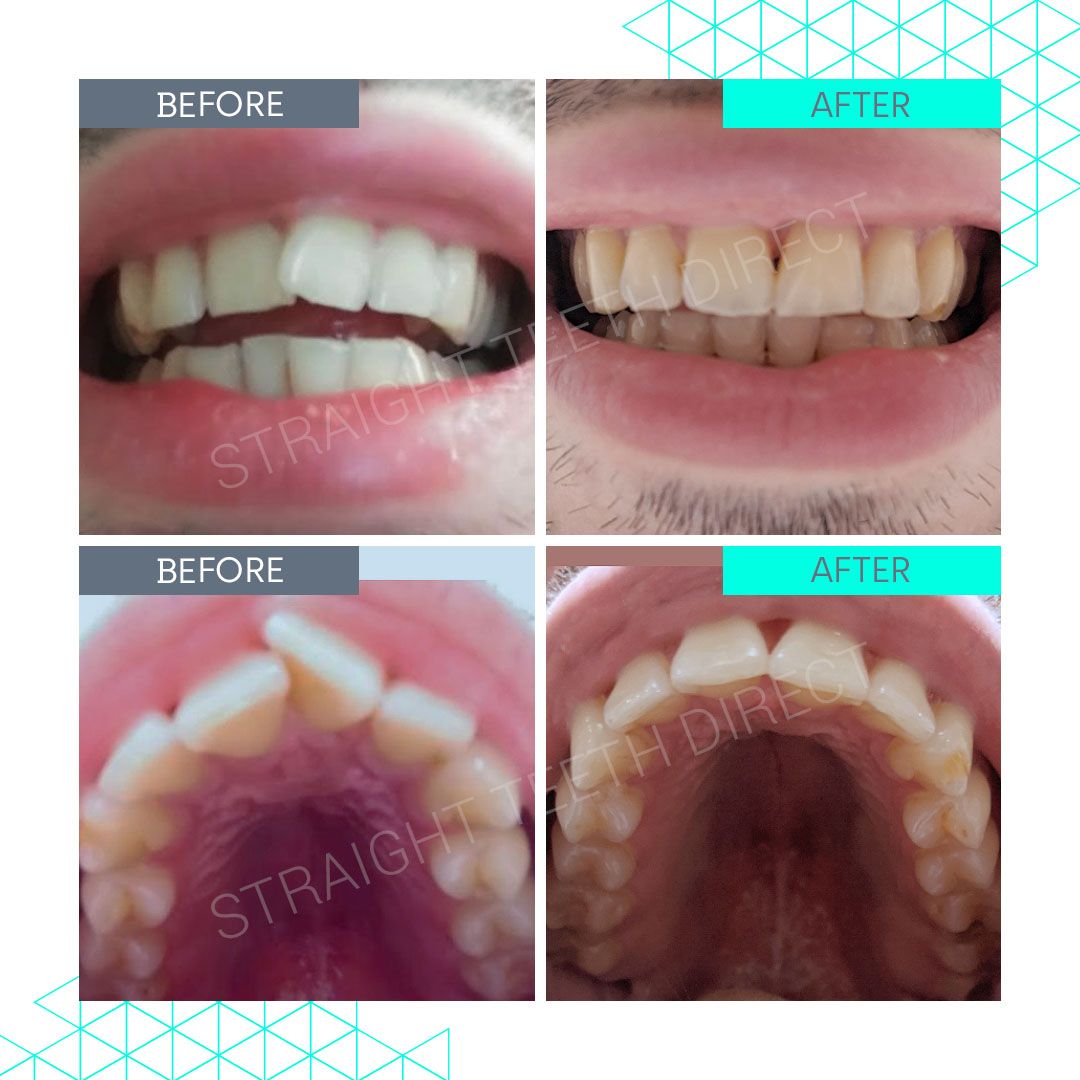 Straight Teeth Direct Review by