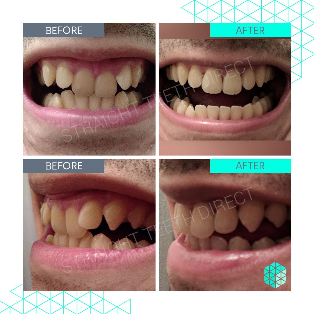 Straight Teeth Direct Review by AB