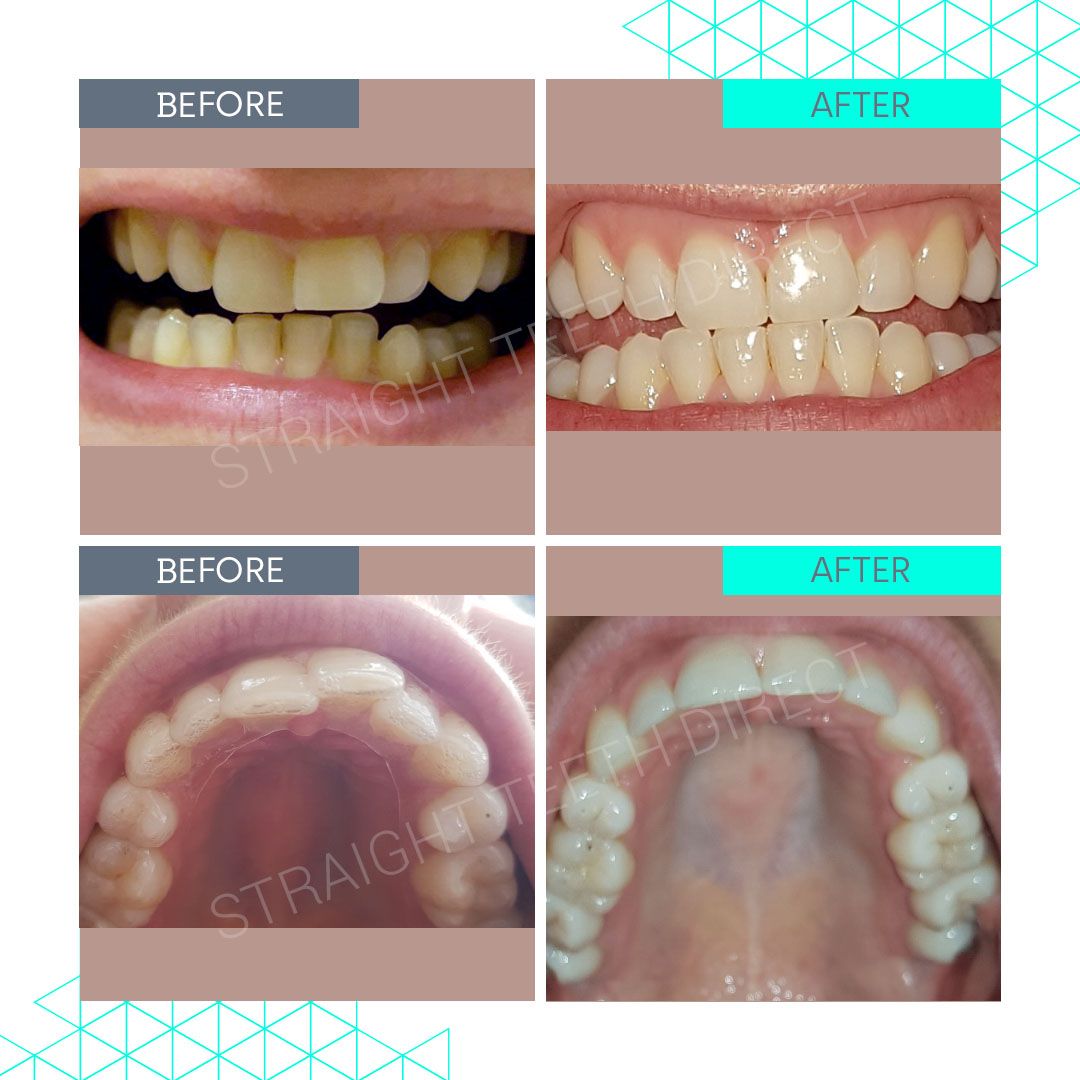 Straight Teeth Direct Review by Alex