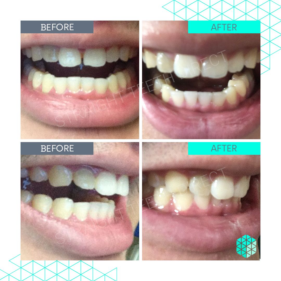 Straight Teeth Direct Review by Alex