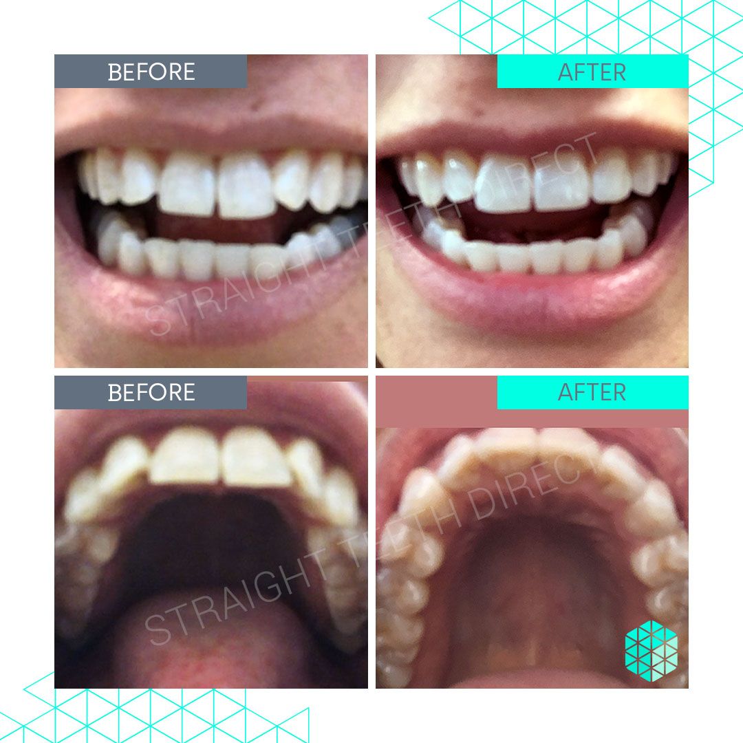 Straight Teeth Direct Review by Alice